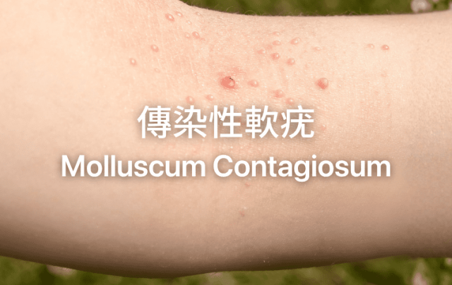 Molluscum Contagiosum — Viral Skin Lesions That Require Proper Medical Diagnosis and Treatment